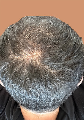 hair transplant photos