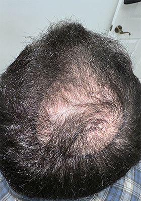 hair transplant photos