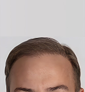 hair transplant photos