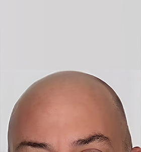 hair transplant photos