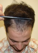 hair transplant photos