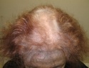 female pattern hair loss