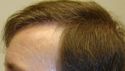 Hair Transplant Expert in florida