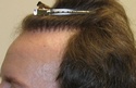 Hair Transplant in florida