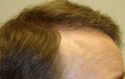 Hair Transplant