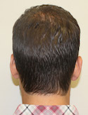 Hair Transplant Back Image