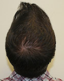 Hair Transplant Images 