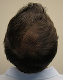 Hair Transplant Images 