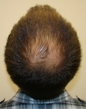 Hair Transplant Images 