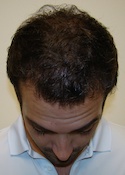 Hair Transplant Images 