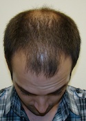 Hair Transplant Images 