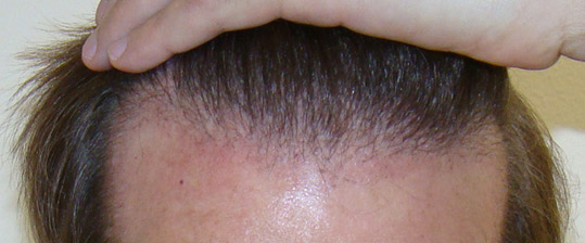 Hair Transpant Patient Photos