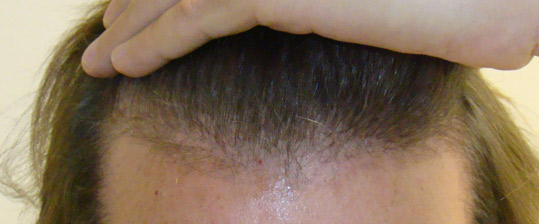 Hair Transpant Patient Photos