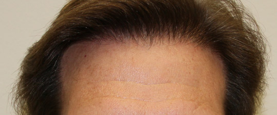 Hair Transpant Patient Photos