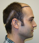 Hair Transplant Images 