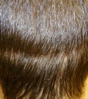 Hair Transplant Images 