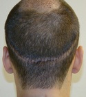 Hair Transplant Images 