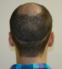 Hair Transplant Images 