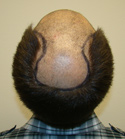 Hair Transplant Images 