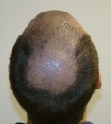 Hair Transplant Images 
