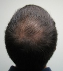 Hair Transplant Images 