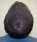 Hair Transplant Images 