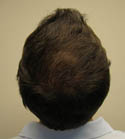 Hair Transplant Images 