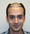 Hair Transplant Images 