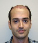 Hair Transplant Images 