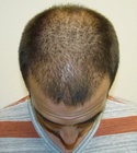 Hair Transplant Images 