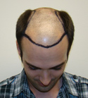 Hair Transplant Images 