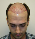 Hair Transplant Images 