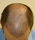 Hair Transplant Images 