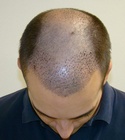 Hair Transplant Images 