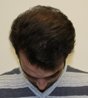 Hair Transplant Images 