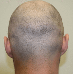 Hair Transplant Fue Scar