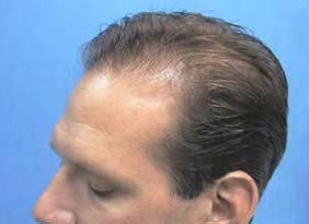 Hair Transpant Patient Photos