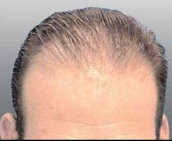 Hair Transpant Patient Photos