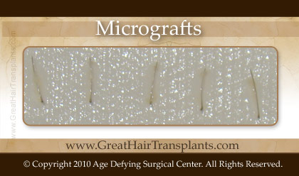 Micrografts or single hair grafts