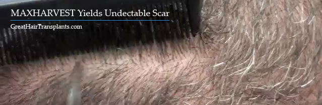 no scar hair transplant