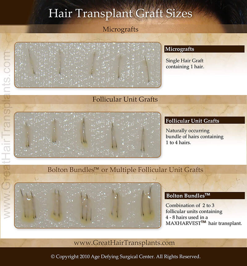 Hair Transplant Graft Sizes