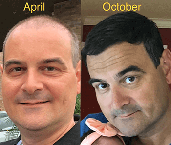 Hair Transplant Patient Photos