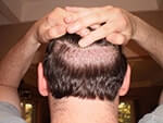 Dr. Brett Bolton Hair Transplant  Suture lines