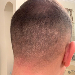 Hair Transplant Fue Scar 