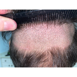 Hair Transplant Fue Scar 