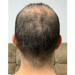 Hair Transplant Fue Scar 