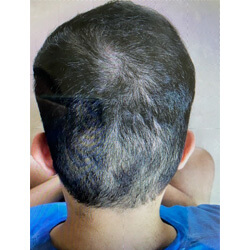 Hair Transplant Fue Scar 