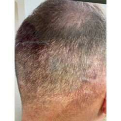 Hair Transplant Fue Scar 