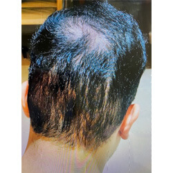 Hair Transplant Fue Scar 