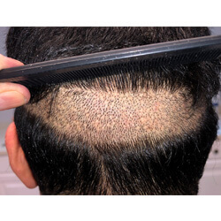 Hair Transplant Fue Scar 